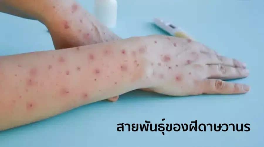The two main strains of Mpox