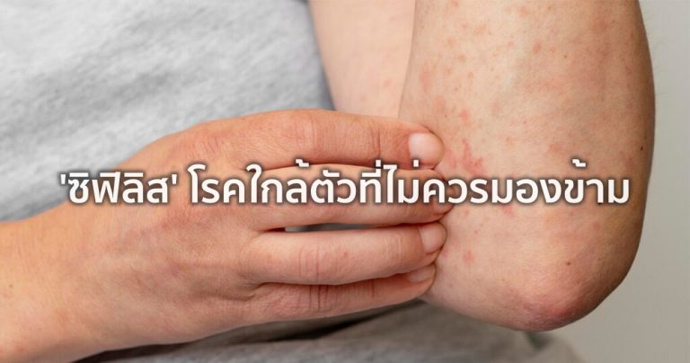 ซิฟิลิส โรคใกล้ตัวที่ไม่ควรมองข้าม