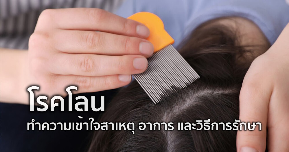 โรคโลน ทำความเข้าใจสาเหตุ อาการ และวิธีการรักษา