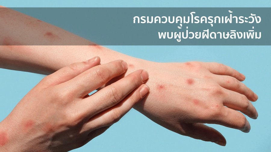 กรมควบคุมโรครุกเฝ้าระวัง พบผู้ป่วยฝีดาษลิงเพิ่ม