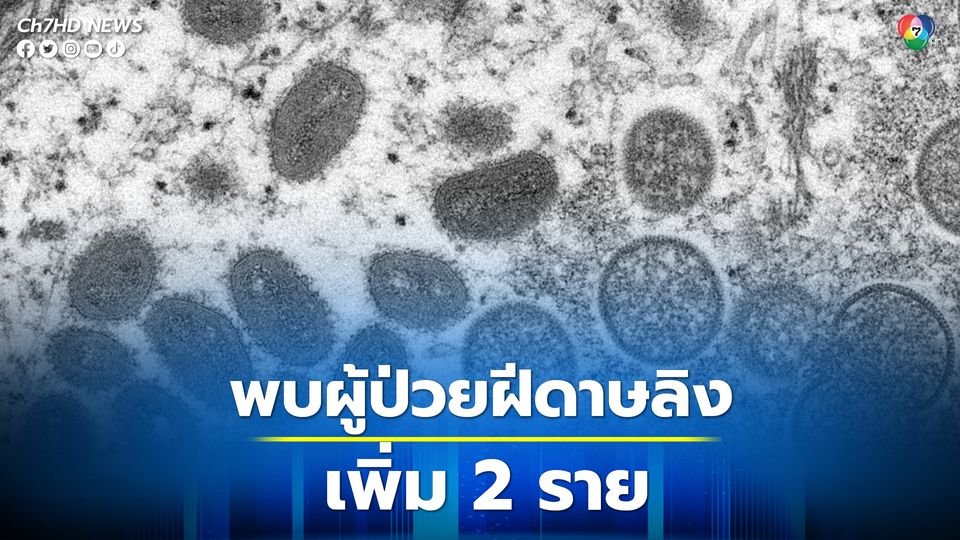 “ฝีดาษลิง” พบป่วยเพิ่มอีก 2 ราย ที่ ภูเก็ต เป็นรายที่ 9 และ 10 ในไทย