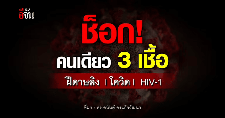 ข่าวฝีดาษลิง 22 สิงหาคม 2565 - รายแรก! ป่วย "ฝีดาษลิง-โควิด-HIV" พร้อมกัน เหตุมีเพศสัมพันธ์ไม่ป้องกัน