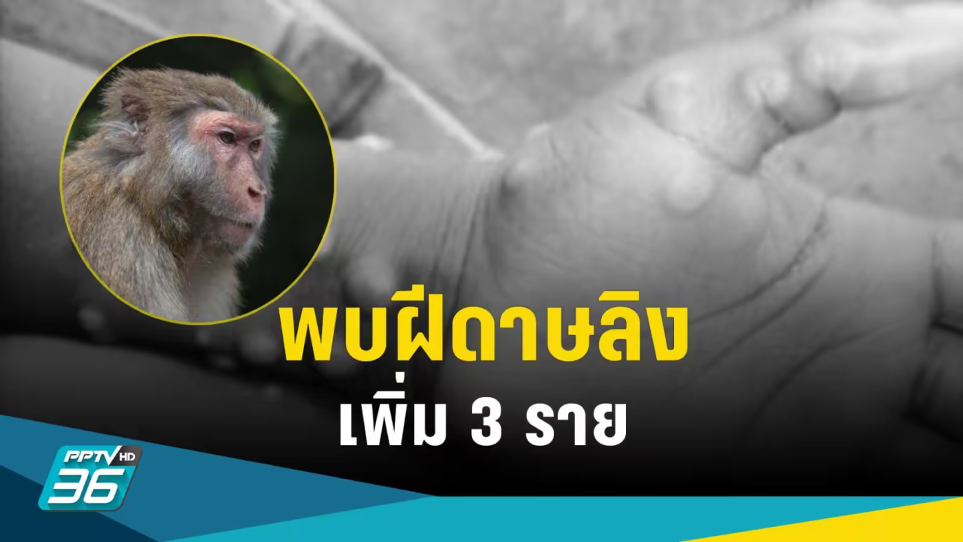 ข่าวฝีดาษลิง 24 มี.ค. 2566 - สธ.พบผู้ป่วยฝีดาษลิง เพิ่ม 3 ราย