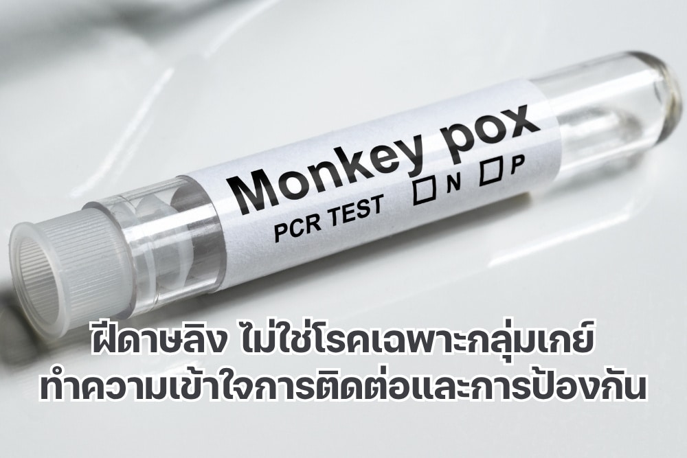 ฝีดาษลิง ไม่ใช่โรคเฉพาะกลุ่มเกย์ ทำความเข้าใจการติดต่อ และการป้องกัน