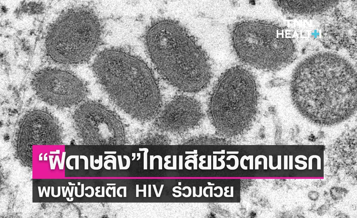 14 ส.ค. 2566 - เสียชีวิตรายแรกจาก “โรคฝีดาษลิง” โดยพบการติดเชื้อ HIV- ซิฟิลิส ร่วมด้วย