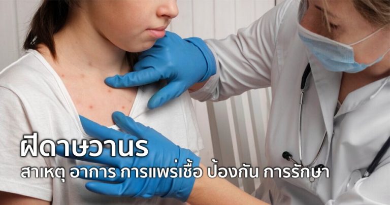 ฝีดาษวานร สาเหตุ อาการ การแพร่เชื้อ ป้องกัน การรักษา