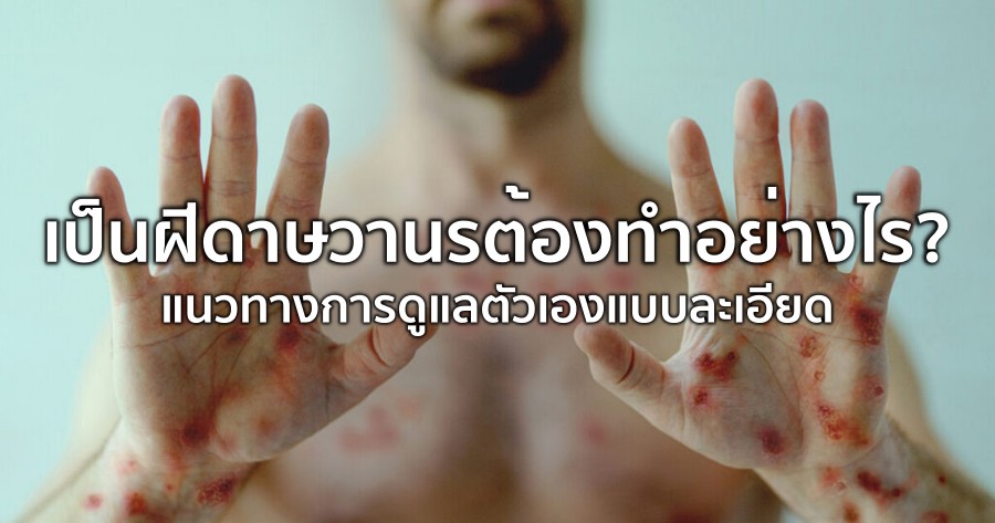 เป็นฝีดาษวานรต้องทำอย่างไรบ้าง มาดูแนวทางการดูแลตัวเองแบบละเอียด
