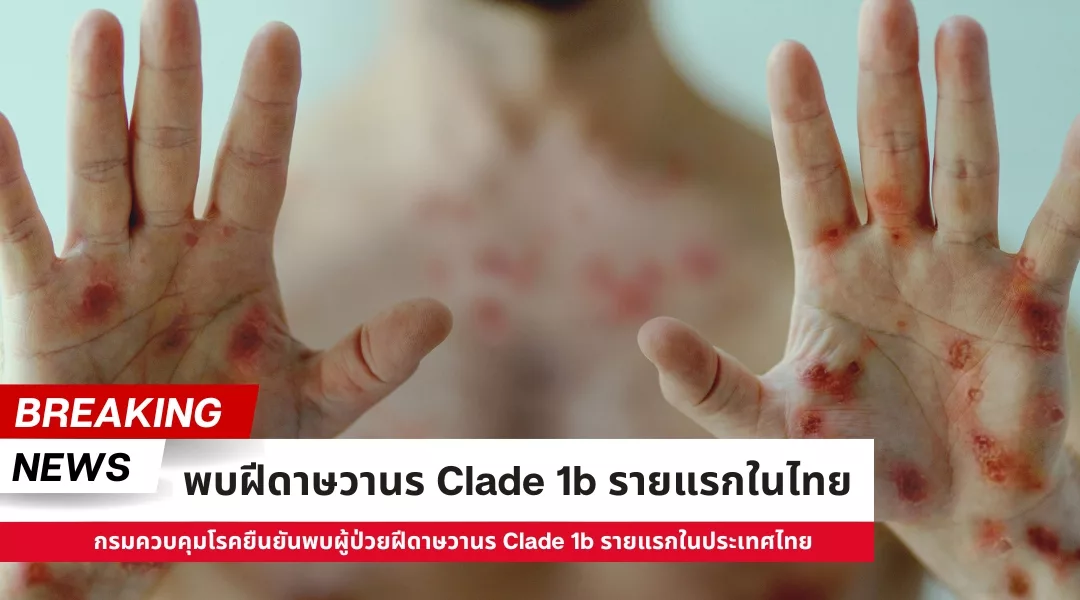 กรมควบคุมโรคยืนยันพบผู้ป่วยฝีดาษวานร Clade 1b รายแรกในประเทศไทย