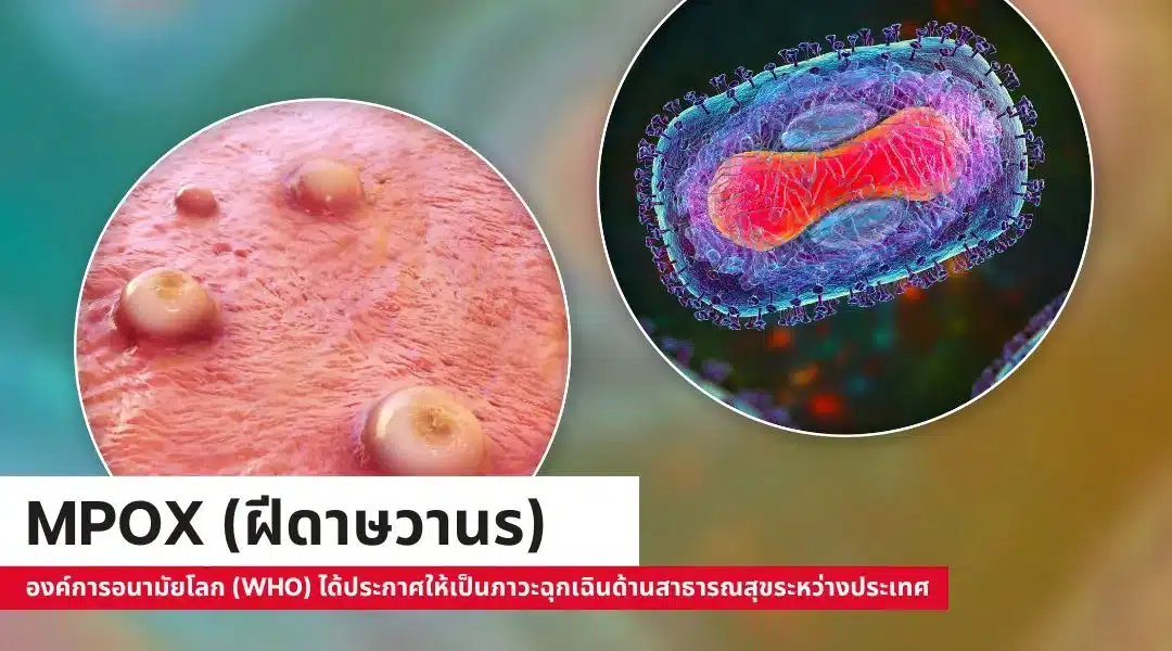 Mpox (ฝีดาษวานร)