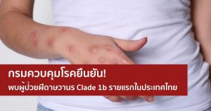 กรมควบคุมโรคยืนยันพบผู้ป่วยฝีดาษวานร Clade 1b รายแรกในประเทศไทย