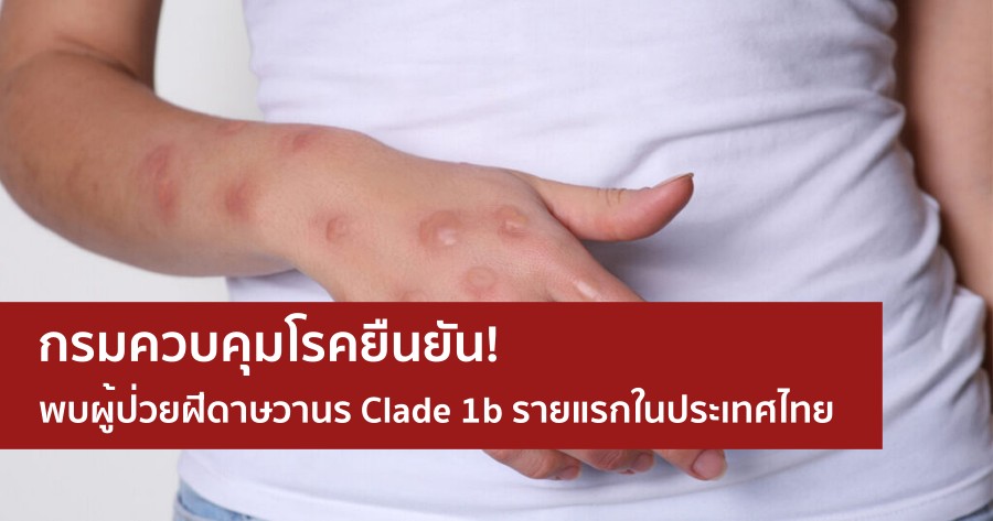 กรมควบคุมโรคยืนยันพบผู้ป่วยฝีดาษวานร Clade 1b รายแรกในประเทศไทย