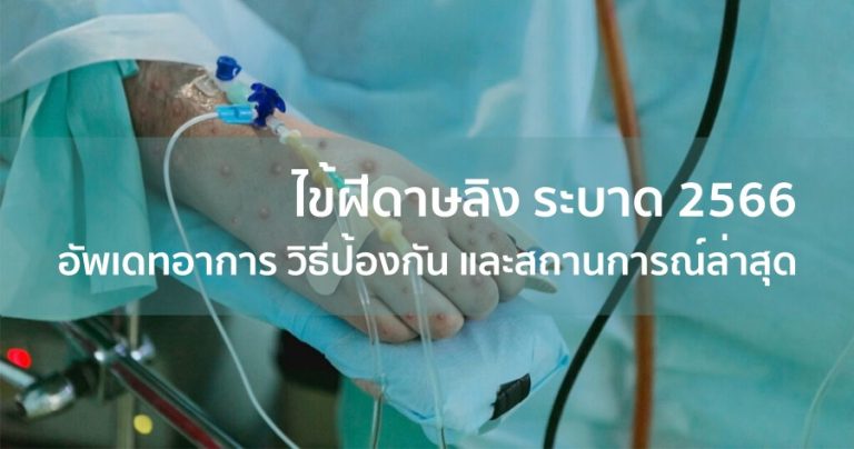 ไข้ฝีดาษลิง ระบาด 2566 อัพเดทอาการ วิธีป้องกัน และสถานการณ์ล่าสุด