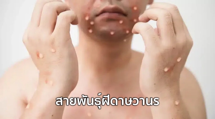 สายพันธุ์ฝีดาษวานร สายตระกูล Clade 1 และ Clade 2