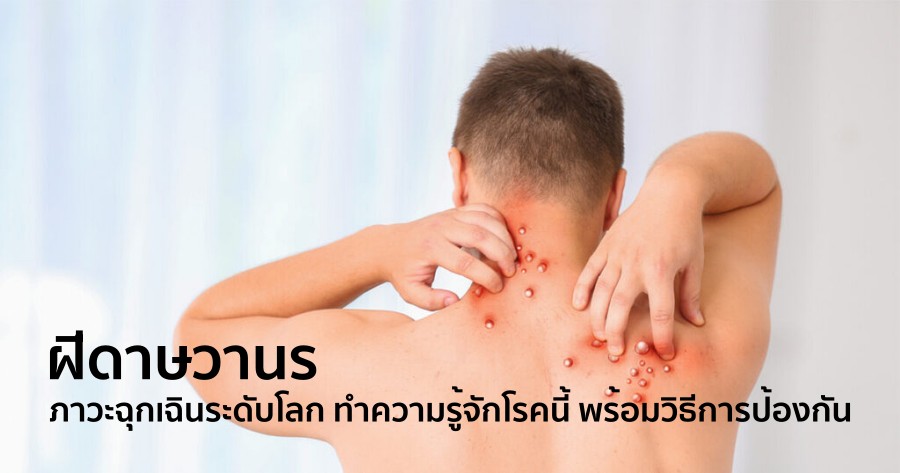 ฝีดาษวานร ภาวะฉุกเฉินระดับโลก ทำความรู้จักโรคนี้ พร้อมวิธีการป้องกัน