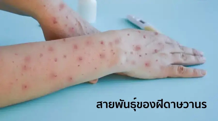 ฝีดาษวานร มีสองสายพันธุ์หลัก