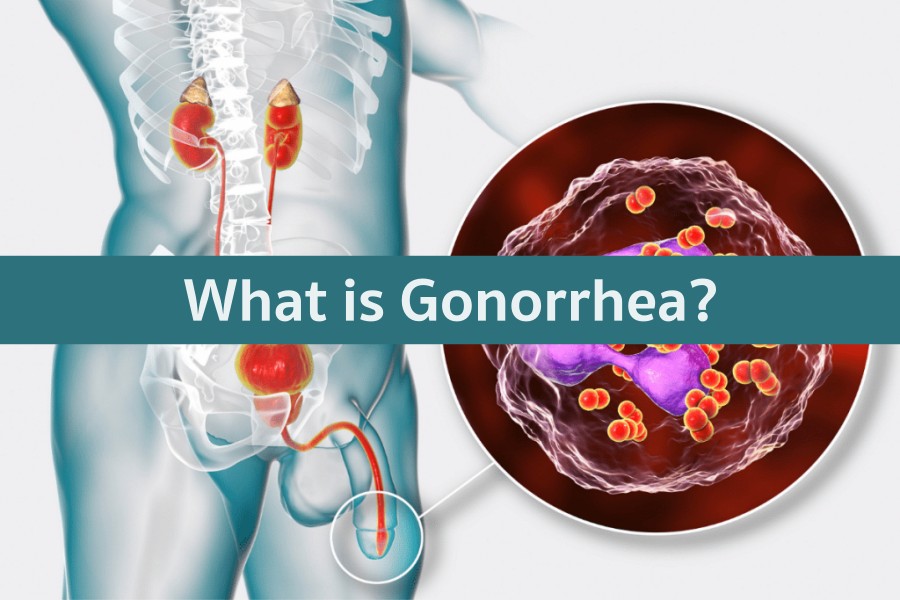 Gonorrhea