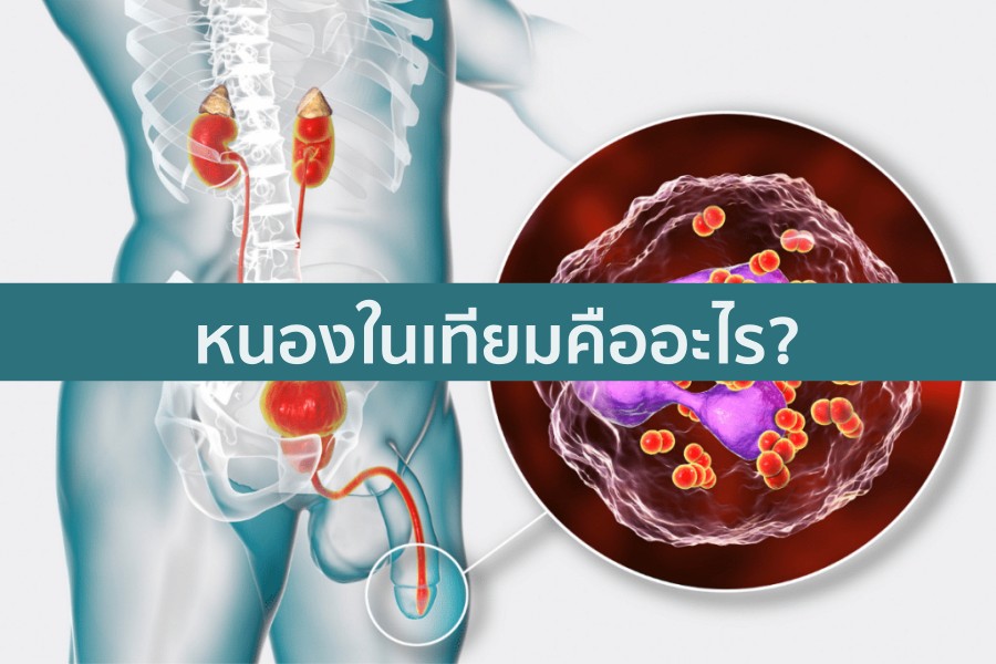 หนองในเทียมคือ อะไร แพร่เชื้อ และรักษาอย่างไร